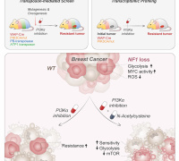 N-acetylcysteine Helps Combat Resistance in Breast Cancer