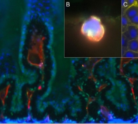 Research challenges “sugar hypothesis” of diabetic cataract development 